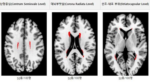 뇌경색 위험 예측지도, 허혈 뇌지도로 뇌 건강나이도 추정 가능