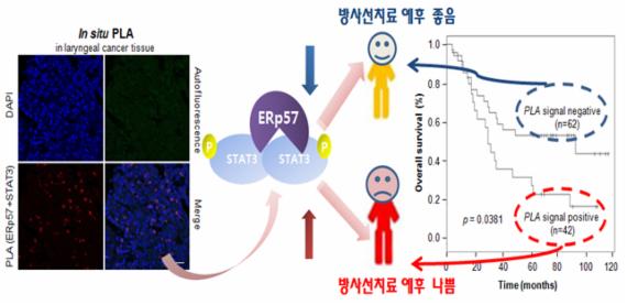 방사선 치료 내성 예측해 후두암 치료 효율 높인다