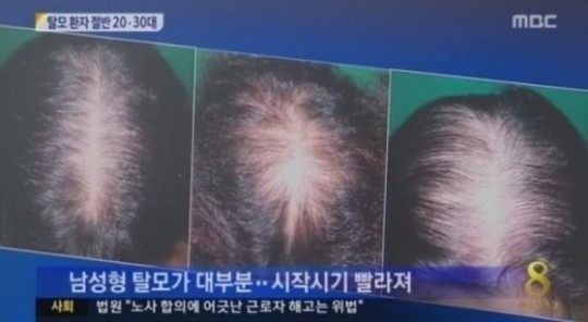 환절기 탈모 예방법, 봄 맞아 관심 높아져