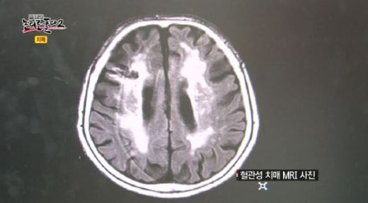 혈관성 치매란, 뇌 조직 소상으로 인한 치매 ‘발병 초기에 잡아야’