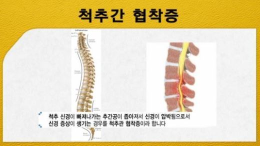 자전거 협착증