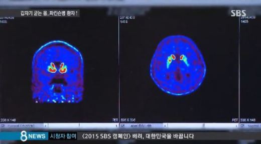 파킨슨병 증상, 노인성 질환인 줄 알았더니… 20대에서도 발병