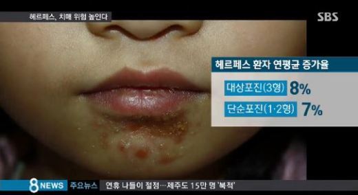 헤르페스 원인, 감염되면 몸속에 평생 존재… 스트레스 높아지면 활성화