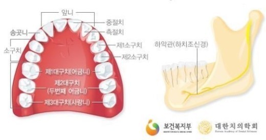 사랑니 발치 후 주의사항, ‘첫사랑’ 앓듯 아픈 ‘사랑니’의 모든것