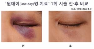 멍, 치료+세포활성 레이저로 하루에 치료가능