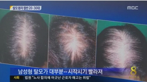 원형탈모 초기증상, ‘아무 증상’ 없다가 ‘갑자기’ 쑥 빠지는 ‘머리카락’