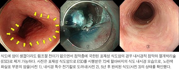 조기 식도암 내시경절제