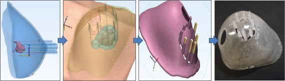 3D 프린터를 활용한 유방 수술 가이드 제작 과정.