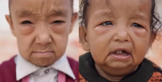 "언제 예뻐져요?" 조로증 남매.. 엄마는 웁니다