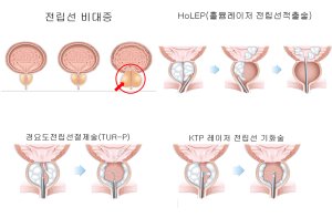 전립선비대증, 홀렙 수술 만족도 90% 이상
