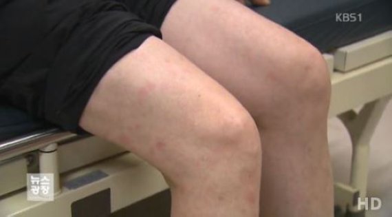 콜린성 두드러기 증상, 체온 상승시 발생…“원인은 불명”