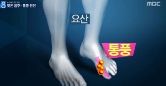 통풍 원인, 요산 농도…방치시 심각한 합병증 ‘고요산혈증-간헐기-만성 결절성 통풍’