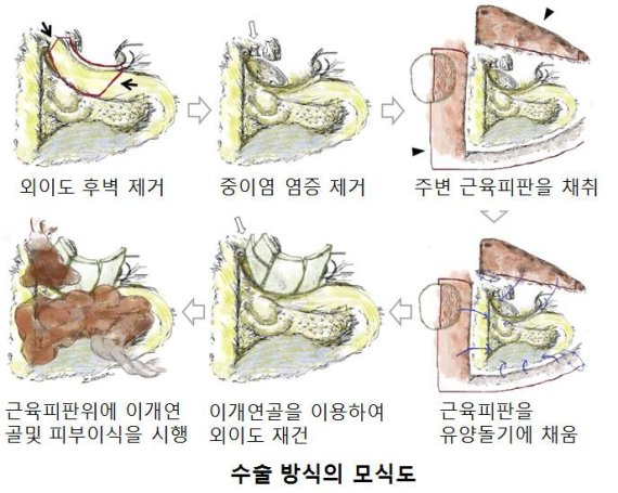 춘천성심병원, 만성중이염 수술법 '자가이개연골 및 근피판을 이용한 외이도 재건 및 유양돌기 폐쇄술' 개발