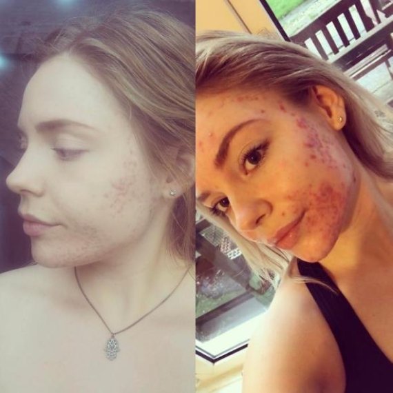 오른쪽이 두 달전과 왼쪽이 현재 모습 [사진=레이첼 크롤리 인스타그램]