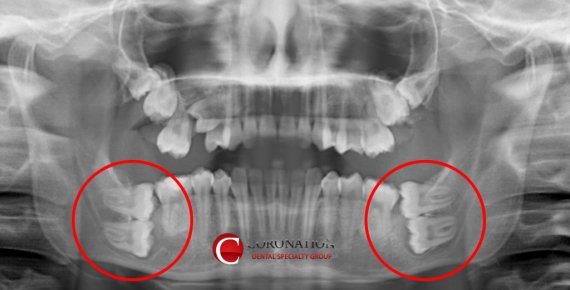 하악 양쪽 총 네 개의 사랑니가 누워 있는 것을 발견할 수 있다/사진='Coronation Dental' 홈페이지