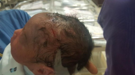 지난 7월 1일 경기 분당 차병원에서 제왕절개 수술 중 메스에 베이는 사고가 발생, 봉합수술을 받은 신생아. 사진=피해가족 제공