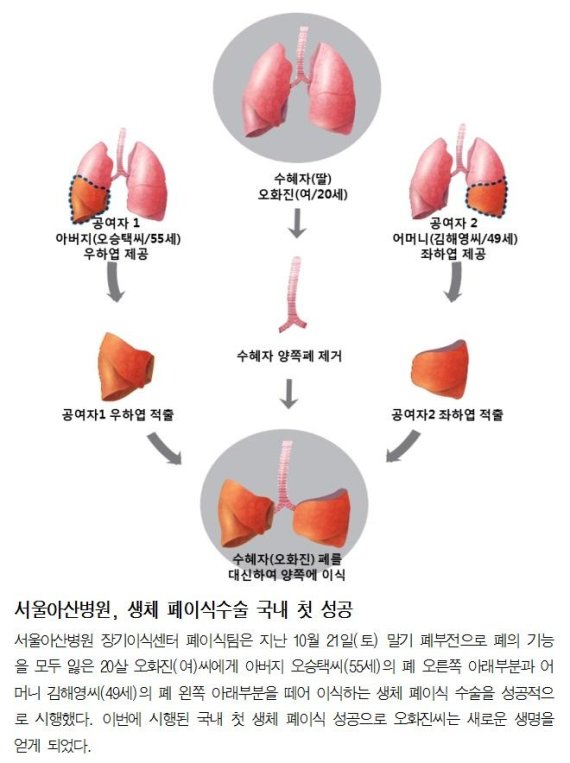 서울아산병원, 국내 생체 폐이식 첫 성공