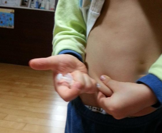 김미영씨의 아들 정근우군(가명)은 어릴 때부터 1형 당뇨병을 앓아 혈당 관리를 위해 하루에 10번 이상 피를 뽑고 인슐린 주사를 맞아야 했다. 김씨는 고통을 줄여주는 연속혈당측정기를 공동구매했다가 최근 식품의약품안전처 조사를 받고 검찰에도 소환될 상황에 놓였다.