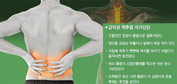 [yes+ Health] 자고 일어나니 허리 통증.. 젊은 男 '강직성 척추염' 조심