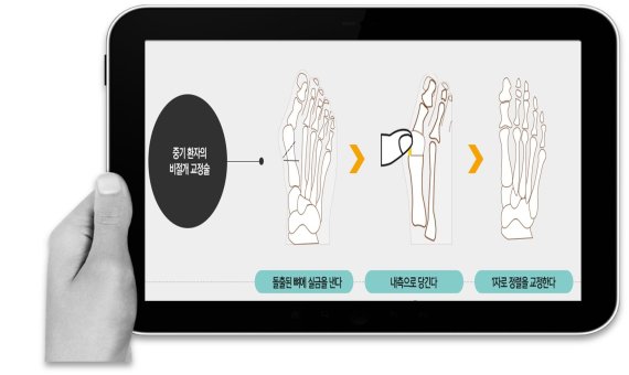 연세건우병원, '무지외반증' 비절개 교정술로 치료 부담 개선