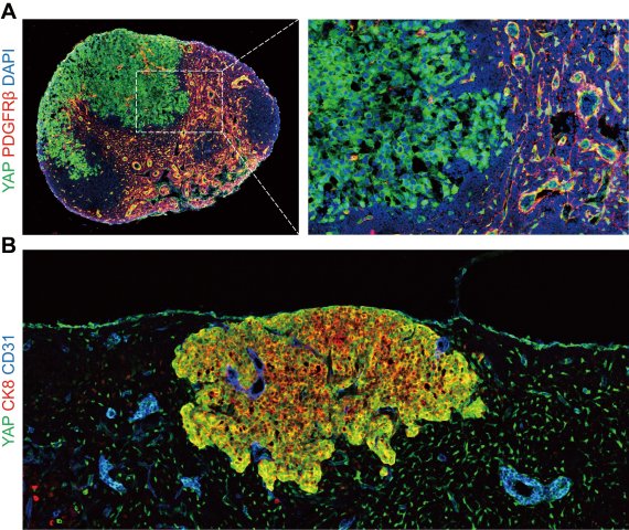 암세포의 림프절 전이에 있어서의 전사인자 YAP의 역할 연구진은 림프절에 전이된 흑생종(그림A)과 유방암(그림B) 모델 생쥐의 암세포를 형광염색법을 이용해 현미경으로 관찰했다. 두 이미지 모두에서 YAP 전사인자(진한 녹색)가 활성화됨을 확인할 수 있었다.