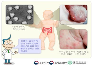 수족구병 환자 발생 증가, 올바른 손씻기 생활화 당부