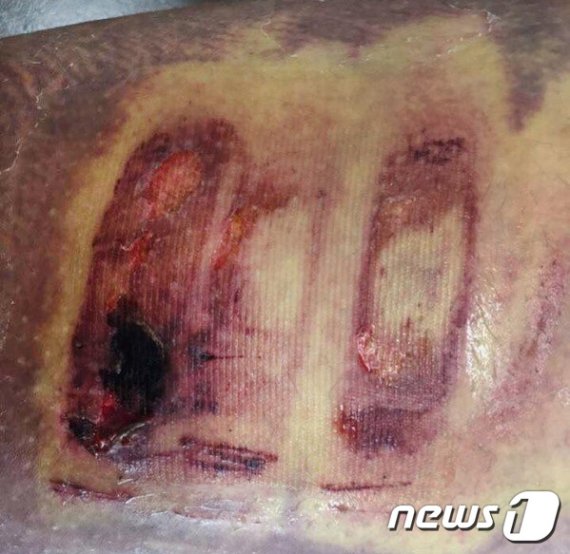 칠곡 중·고생 집단폭생 피해 학생이 허벅지에 상처 입은 모습(독자제공)2019.6.24/© 뉴스1