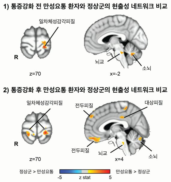 그림1: 만성요통 환자와 정상군 간의 현출성 네트워크 비교 뇌영상의 붉은색 계열로 표시된 영역은 만성요통환자가 정상군에 비해 일차체성감각피질과 현출성 네트워크간의 기능적 뇌 연결성이 증가한 곳임. (그림에 표시된 일차체성감각피질은 신체부위 중 허리의 감각을 처리하는 영역임.)