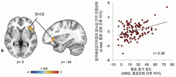그림2: 일차체성감각피질과 현출성 네트워크의 주요 영역인 앞뇌섬 피질간의 연결성과 통증의 변화간의 상관성 요통 환자의 허리통증을 강화시켰을 때, 통증이 심할수록 현출성 네트워크의 대표적 영역인 앞뇌섬 피질과 일차체성감각피질 간의 기능적 연결성이 크게 증가함.