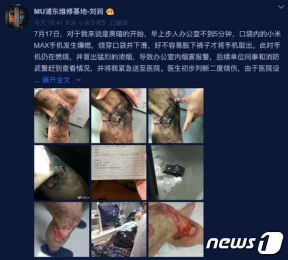 샤오미 맥스(Max) 스마트폰이 중국에서 폭발해 이용자가 화상을 입었다. (Liu Lun웨이보 갈무리) © 뉴스1