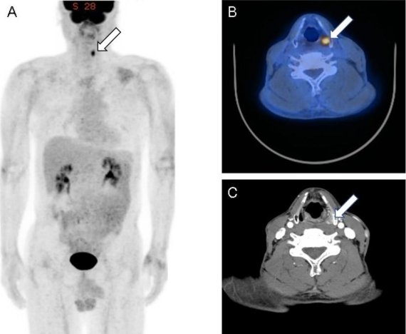 식도암 근치적 수술 29개월 후 검사한 FDG PET/CT 검사에서 임상적으로 의심되지 않았던 왼쪽 하인두에 이차성 원발암(하얀 화살표)이 발견됐다.