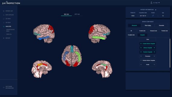 에이스트로캔(ATROSCAN)의 뇌 MR 영상 분석 화면/사진=제이엘케이인스펙션 제공