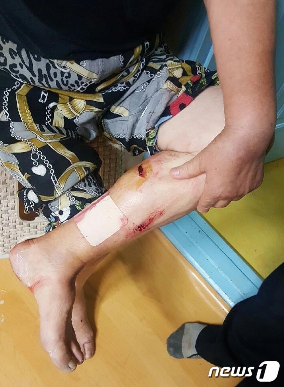 31일 오전 5시쯤 부산 동구 수정동의 한 주택에서 집 안으로 들어온 핏불테리어가 70대 여성을 공격하는 일이 벌어졌다. 피해자 A씨(78·여)가 핏불테리어에 물린 다리 상처.(부산소방재난본부 제공)© 뉴스1