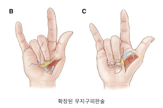 확장된 무지구 피판술을 이용하면 손 끝의 절단된 부위에 피판 부위를 넓게 적용해 재건할 수 있다.
