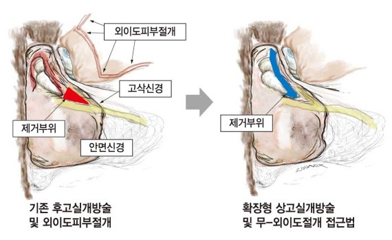 기존 수술법(좌측)은 외의도 절개 후 안면신경과 미각신경 사이에 구멍(제거부위)을 내야하기 때문에 수술이 까다롭고 후유증이 발생할 가능성도 높았다.