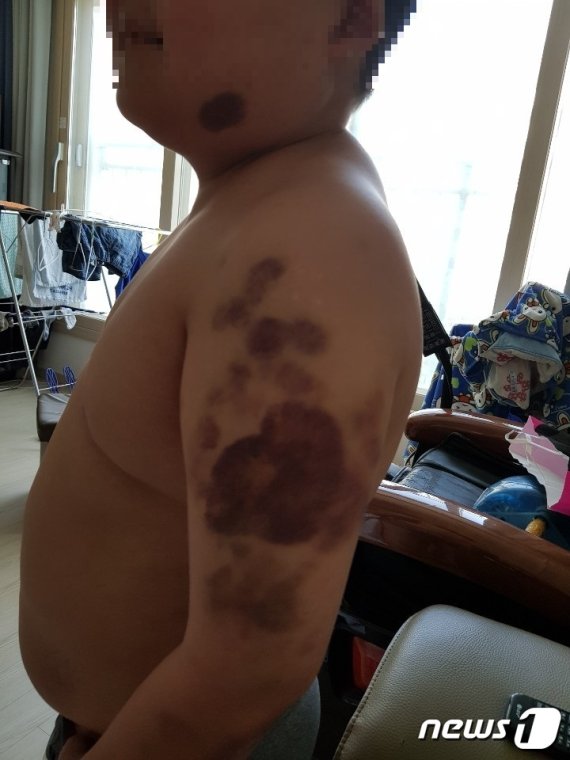 학부모 A씨가 공개한 아들 B군의 모습. 수차례 폭행으로 온몸에 심한 멍이 들었다. [사진=뉴스1]