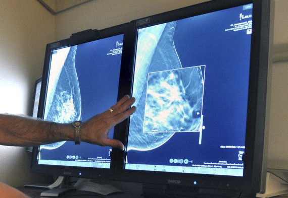 FILE - This July 31, 2012, file photo shows a mammogram, a test to detect cancer. A new study suggests that adding MRIs to mammograms to screen women with very dense breasts may find more cancers but also gives a lot of false alarms. (Torin Halsey/Times Record News via AP, File) /뉴시스/AP /사진=