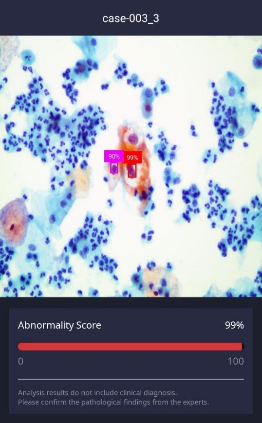 두에이아이의 자궁경부암 조기진단을 위한 인공지능 개발 버전의 데모 화면. 두에이아이 제공.