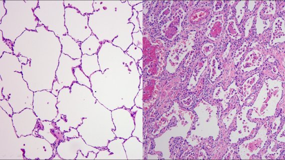 정상 폐 현미경 사진(왼쪽), 코로나19 환자(오른쪽)