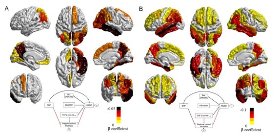 대뇌피질위축정보와 구조방정식 모델을 통해 새롭게 찾아진 유전인자가 뇌의 두정엽과 후두엽의 뇌위축을 유발함을 확인했다. 이 패턴은 아밀로이드 및 타우 단백질에 의한 뇌위축 패턴과 달랐다. KAIST 제공