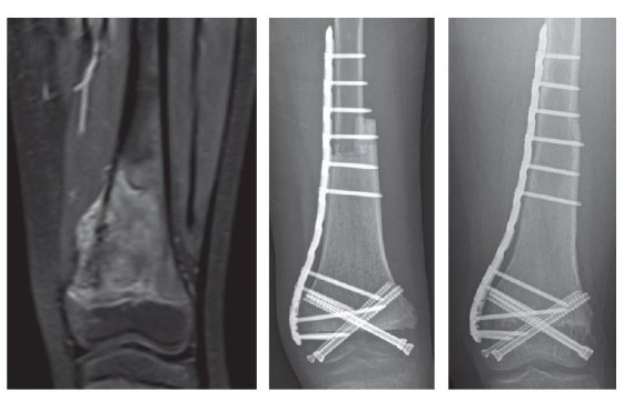 환자에게 MRI 상 종양(왼쪽)이 발생해 수술 직후(가운데)와 수술 후 4년 이후(오른쪽)를 촬영한 단순방사선 사진. 환자 종양을 제거한 부위를 골이식으로 개건해 환자의 무릎관절운동은 정상수준까지 회복됐다. 서울대병원 제공
