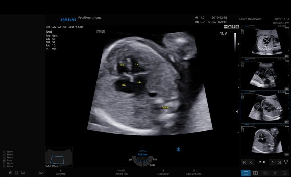 하트어시스트를 실행하면 태아 심장 초음파 화면에서 자동으로 심장을 인식하고 주석을 표시해준다. 삼성메디슨 제공