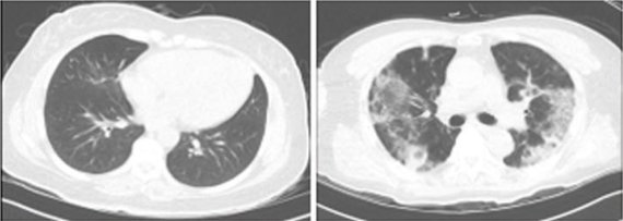 코로나19 환자의 혈액 속에 특정 단백질 'SREBP-2'가 많은 환자(오른쪽)와 적은 환자를 컴퓨터 단층촬영(CT) 영상으로 확인한 결과 단백질 수치가 높은 환자의 폐가 많이 손상됐다. 생명공학연구원 제공