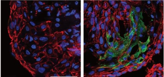 연구진이 배양한 인간의 3D 폐포 세포(왼쪽)와 코로나19 바이러스 감염후 3일이 경과한 모습(오른쪽)이다. 사진 속의 파란색은 세포의 핵을 나타낸 것이고 빨간색은 E카데린이라는 단백질로 이 세포가 폐포 세포 자라고 있다는 것을 뜻한다. 녹색으로 표시된 부분은 코로나19 바이러스가 만들어내는 단백질로 폐포 세포들이 바이러스에 감염됐다는 것을 보여준다. KAIST 주영석 교수 제공
