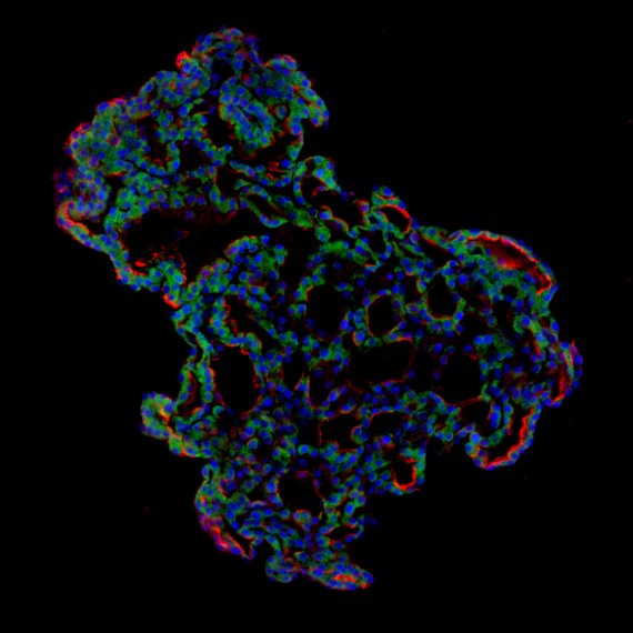 주영석 교수 연구팀이 인간의 폐포 줄기세포를 이용해 실험실에서 배양한 3차원 폐포 세포. 세포 안의 검은색 부분은 폐포에 공기가 들어가 있는 것을 나타내고 있다. 파란색은 폐 세포의 핵, 빨간색은 단백질 'HT2-280'으로 폐 세포가 자라고 있다는 것을 보여준다. 녹색은 ACE2라는 단백질을 표시하고 있는데 이것은 코로나19 바이러스가 세포로 침투할때 필요로 하는 물질이다. KAIST 주영석 교수 제공