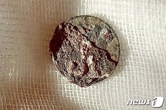 남성의 코에서 발견된 동전. © 뉴스1