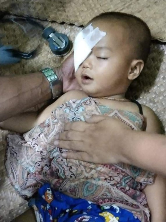 미얀마 군경이 지난 27일 시위대에 무차별 총격을 가해 100여명이 숨지는 참사가 발생했다. 사진은 집 앞에서 놀다가 진압군이 쏜 고무탄에 오른쪽 눈을 다친 1살짜리 여아의 모습./사진=뉴시스