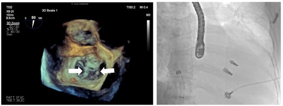 3D 심장초음파에서 보이는 마이트라클립 장착된 모습(왼쪽)과 승모판막에 고정된 마이트라 클립 2개