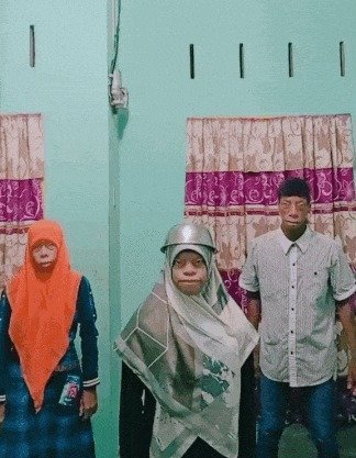 '트레처콜린스증후군'을 앓고 있는 수르야 남매가 음악에 맞춰 춤을 추고 있다. (틱톡 갈무리) © 뉴스1