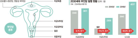 "젊은데…" 설마하다, 2030 부인암 급증 정기 검진 꼭! 초기발견 땐 완치율 높아 [Weekend 헬스]